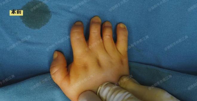 并指免植皮 案例33《张不开拿不了大东西